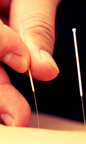 imagen_acupuntura